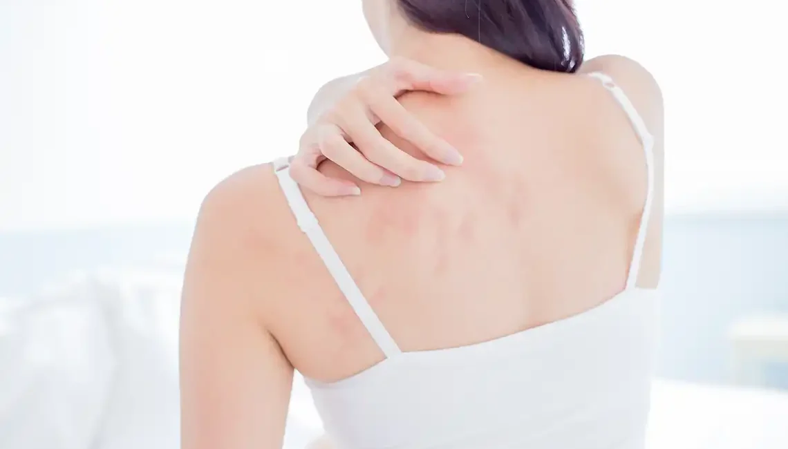 dermatitis atopica
