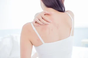 dermatitis atopica