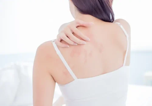 dermatitis atopica
