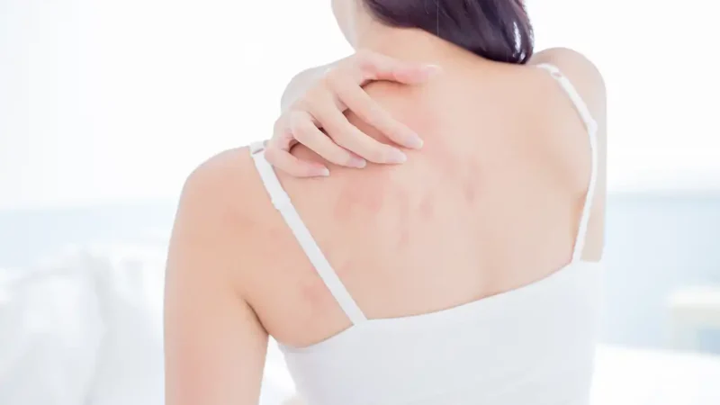 dermatitis atopica