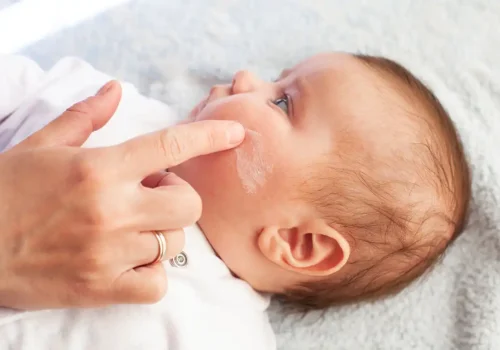 bebe dermatitis