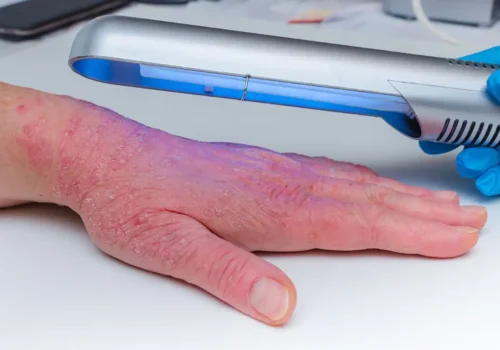 mano con psoriasis